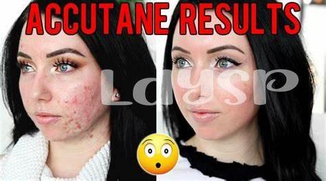 Effetti Collaterali Di Accutane Crema: Cosa Aspettarsi